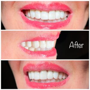 Teeth Whitening near Spring 77379