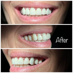 Teeth Whitening near Spring 77379