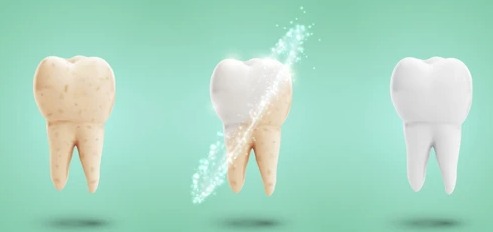 Teeth Whitening In Spring