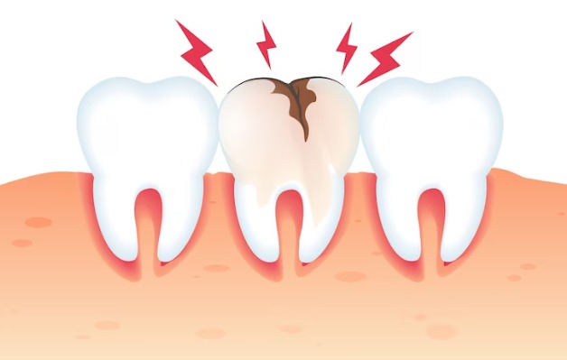 Broken Tooth Treatment In Tx 77379