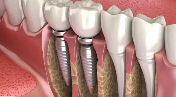 Root canal treatment in Humble, TX